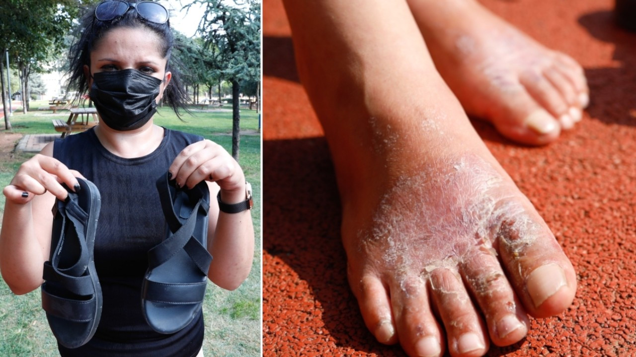 Woman develops skin infection from shoes made of hazardous materials