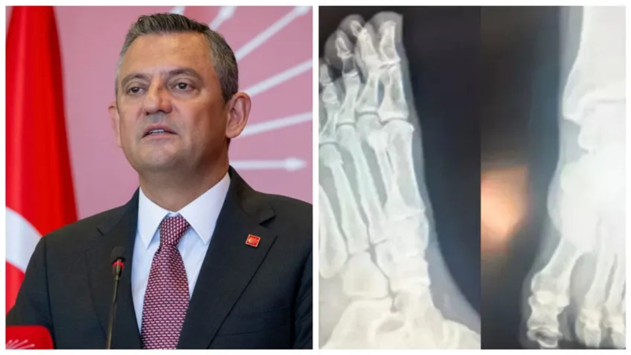 CHP leader shares x-ray film of his broken foot over allegations that he was shot