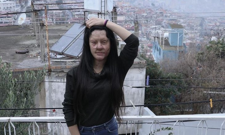 Turkish woman who survived acid attack forgives perpetrator ex-boyfriend